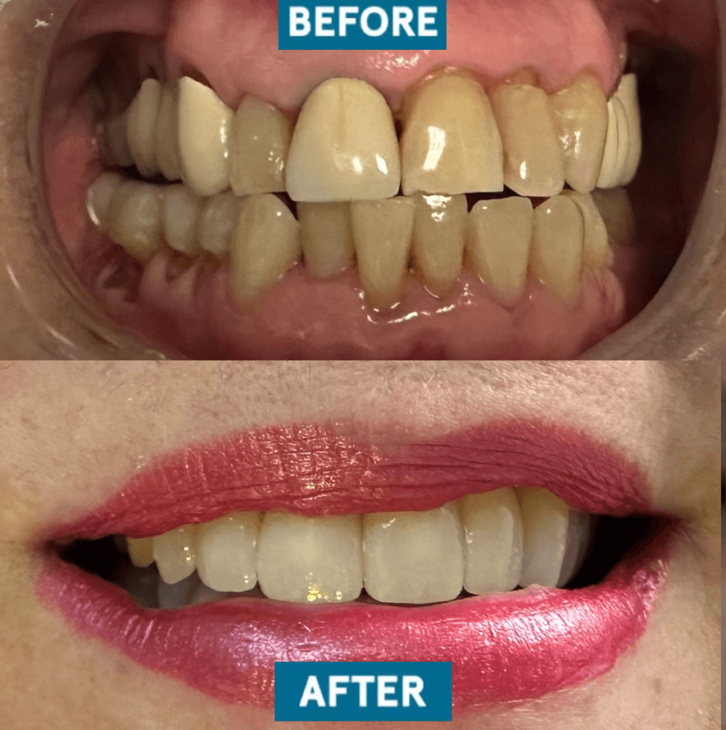 before and after dr franco case 3