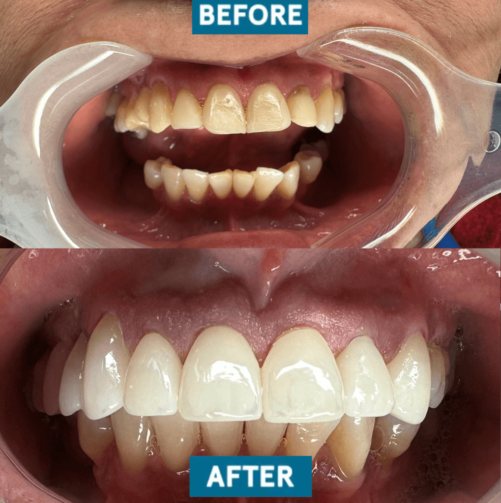 before and after dr franco case 6