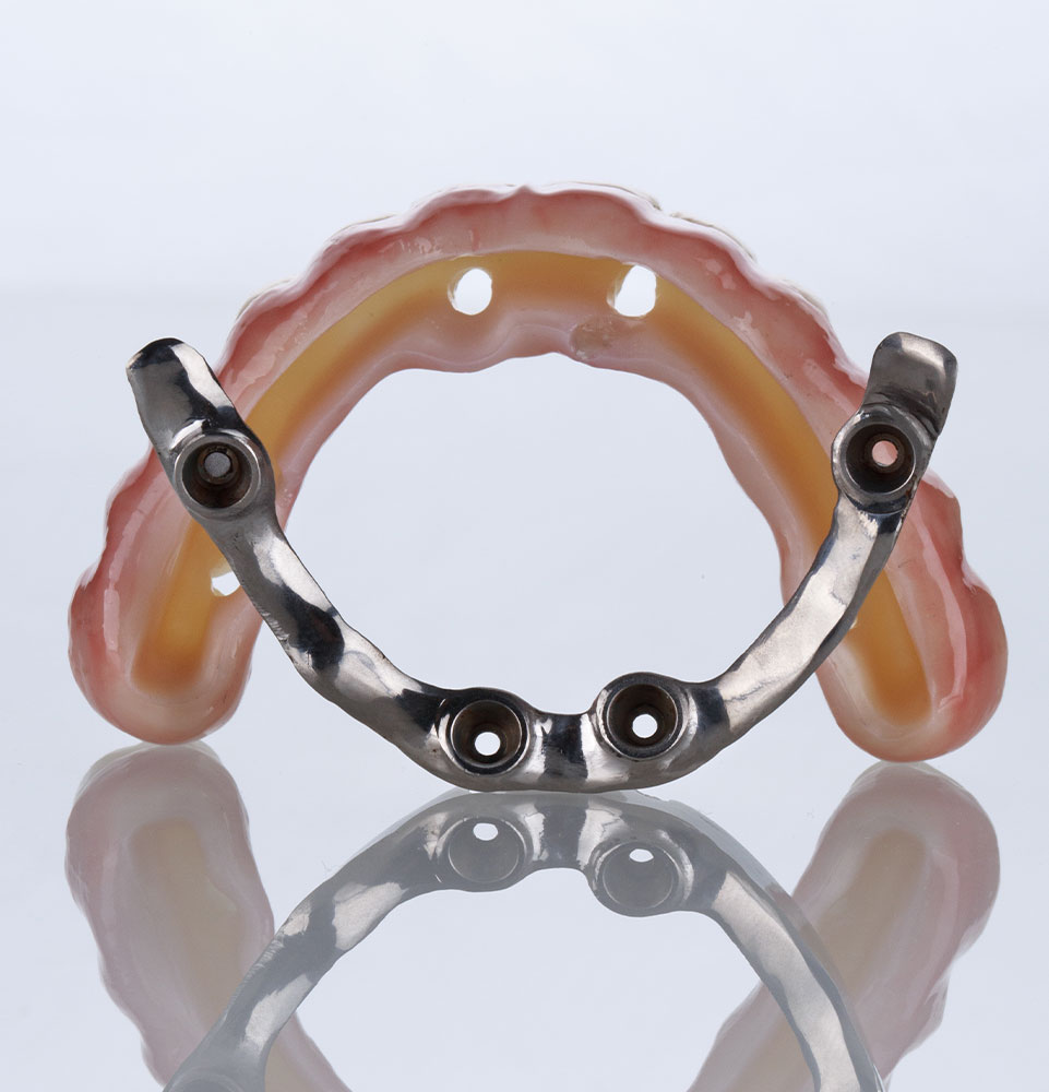 over denture anchor