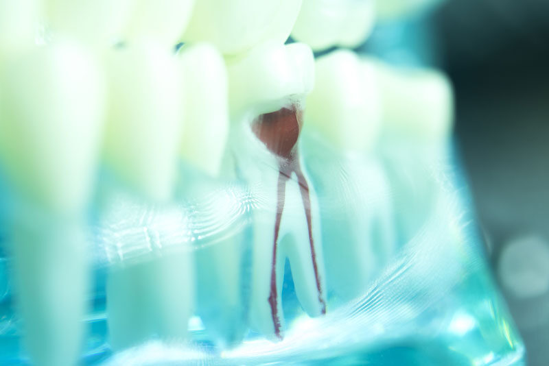 root canal model
