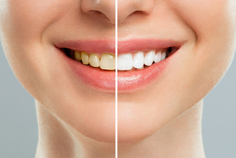 teeth whitening before and after