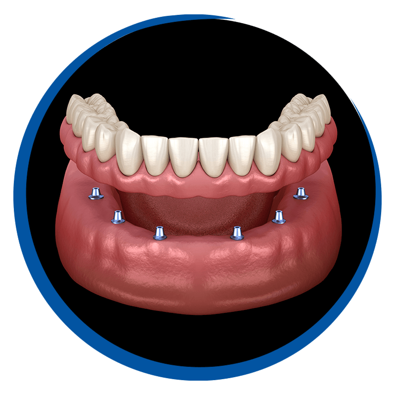 implant supported 3d