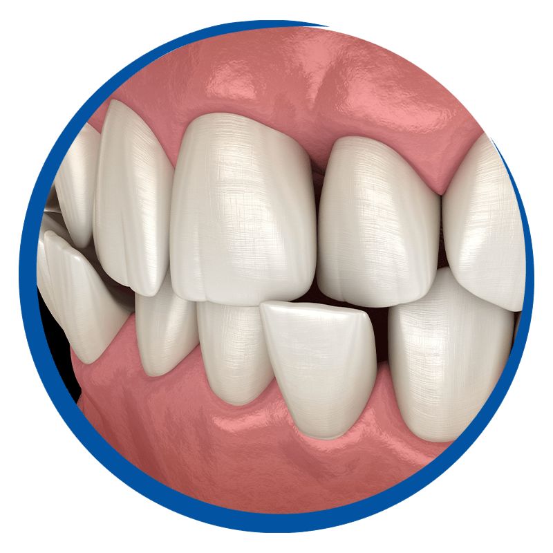misaligned teeth